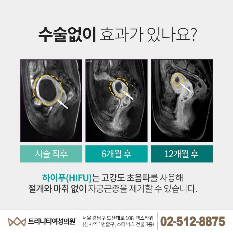 하이푸 시술 직후·6개월·12개월 MRI 추적 비교 자료
