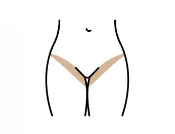 비키니 제모