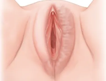 비대칭 / 비대한 대음순